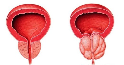 河池前列腺囊肿的典型表现有哪些