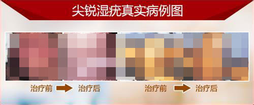 尖锐湿疣治疗费用多少 尖锐湿疣治疗费用多少