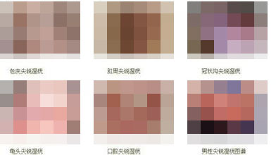 尖锐湿疣能治好吗 尖锐湿疣能治好吗