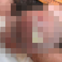 河池淋病有什么样的症状 河池淋病有什么样的症状