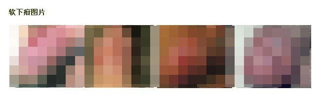 感染软下疳有哪些症状表现 感染软下疳有哪些症状表现