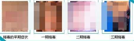 感染梅毒有哪些症状表现