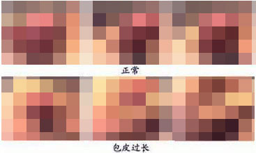 男性包皮过长会引发哪些疾病?