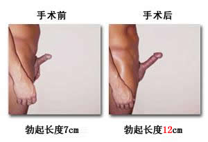 阴茎短小的原因有什么？