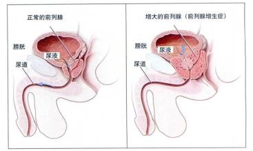 前列腺增生要做什么检查