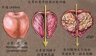 前列腺结石影响性生活吗? 前列腺结石影响性生活吗?
