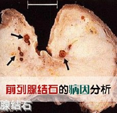 生活中前列腺结石的危害有哪些? 生活中前列腺结石的危害有哪些?