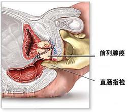 患上前列腺结石有哪些症状 患上前列腺结石有哪些症状