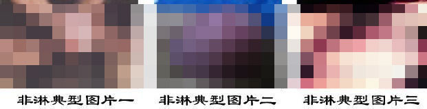 感染非淋有什么危害?