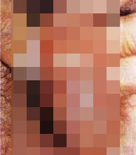 河池生殖器疱疹的危害有哪些 河池生殖器疱疹的危害有哪些