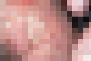 河池男性生殖器疱疹的症状表现